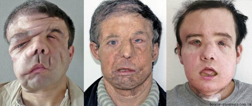 Health News Digest: Frenchman Gets ‘Third Face’ in New Transplant